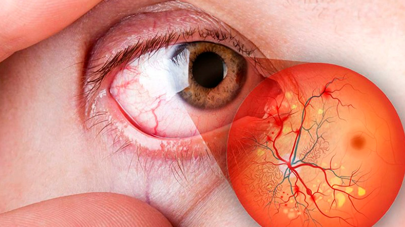 Retinopatia Diabética